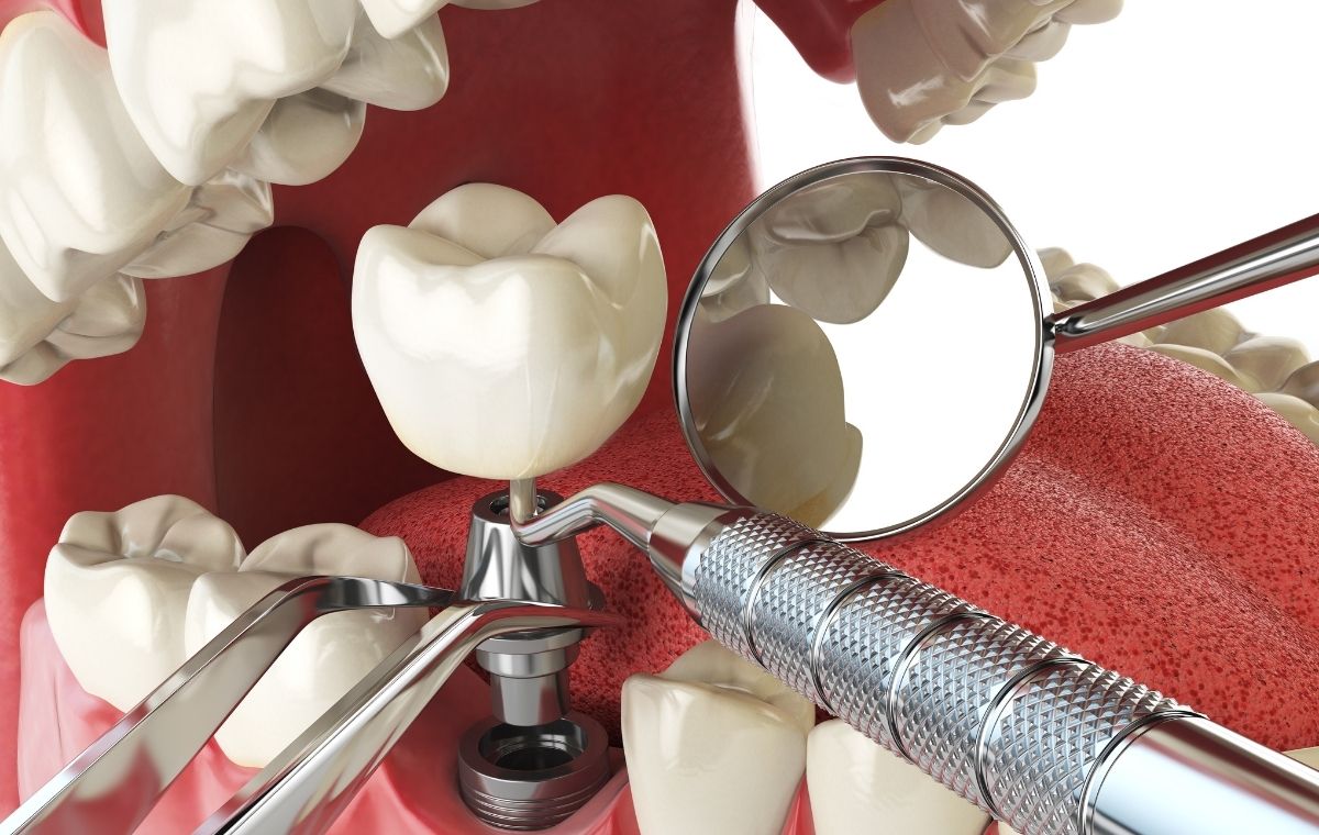 atakent implant tedavisi