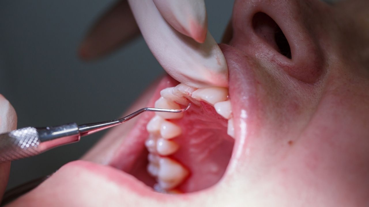 Periodontoloji Tedavisi