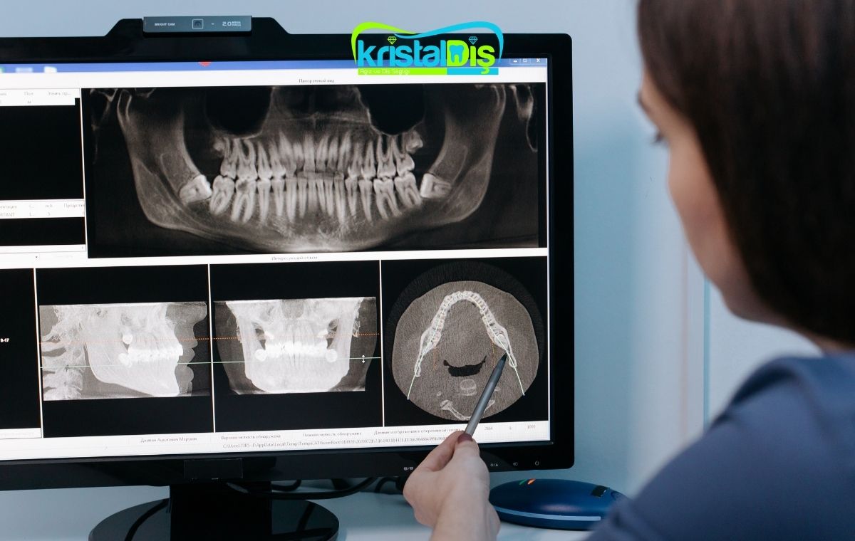 implant çeşitleri nelerdir