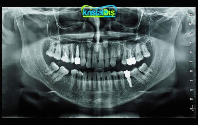 atakent implant tedavisi