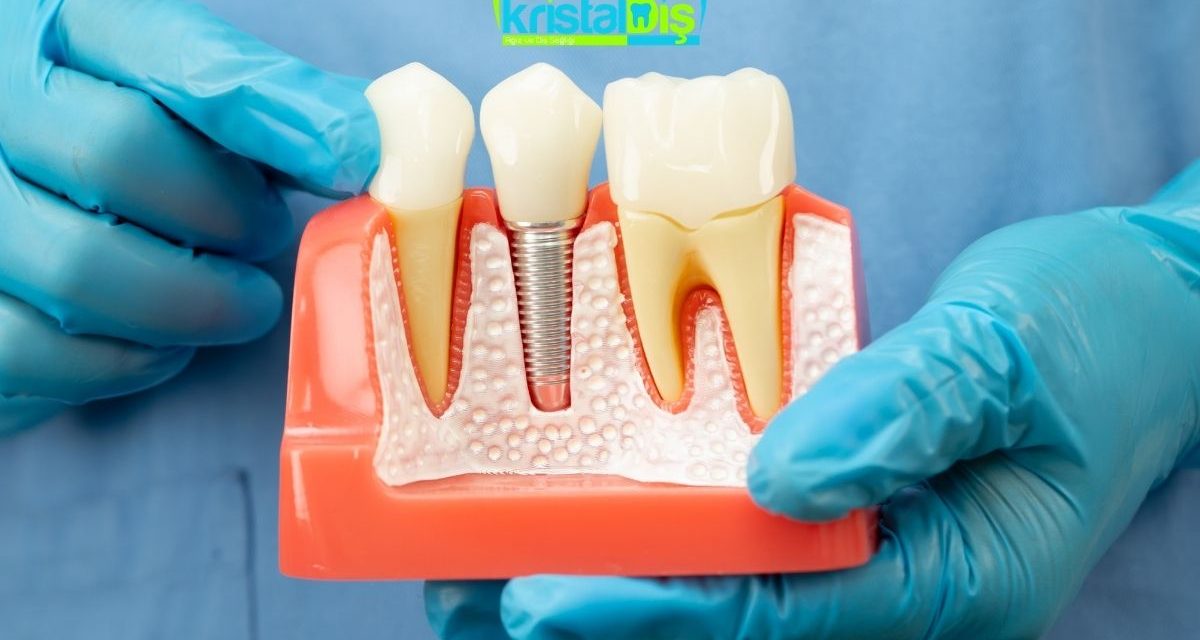 Bahçeşehir Implant Tedavisi