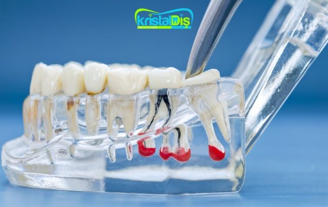 Diş Kisti Nedir?